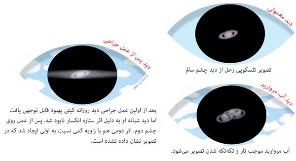 تصویر تلسکوپی زحل از دید فرد دچار آب مروارید