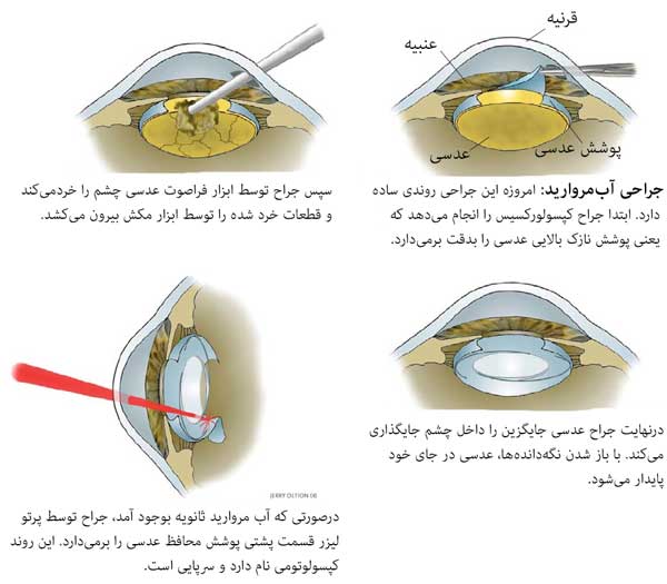 مراحل جراحی آب مروارید