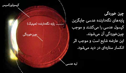 چینخوردگی عدسی مصنوعی